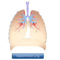 Chronic Obstructive Pulmonary Disease: Three Course Suite Certification Training