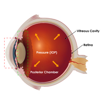 Glaucoma: Cause Certification Training
