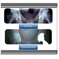 Osteoarthritis: Diagnosis Certification Training