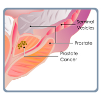 Prostate Cancer: Treatment Certification Training