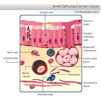 Small Cell Lung Cancer (SCLC): Three Course Suite Certification Training
