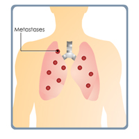 Small Cell Lung Cancer: Treatment Certification Training