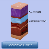 Ulcerative Colitis: Three Course Suite Certification Training